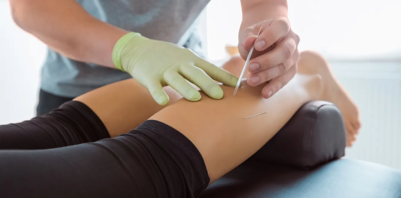 Photo of acupuncture taking place on a person's leg